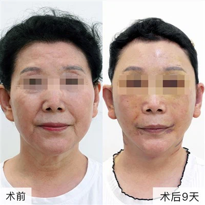 Cirurgia per a les cantonades bucals caigudes